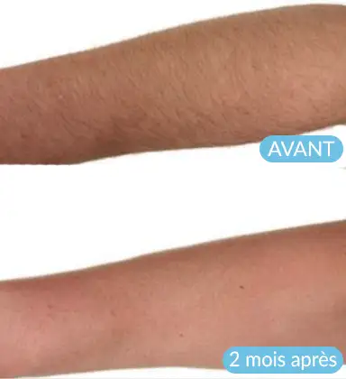 Résultat d'un traitement bleaching sur l'avant bras après 2 mois