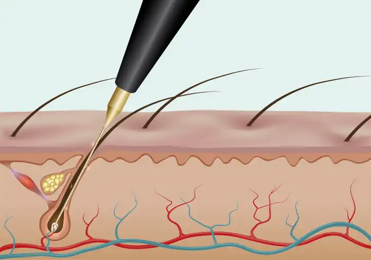 Illustration de la phase d'insertion