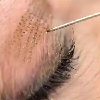 Plasmathérapie sur une paupière